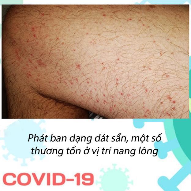 Phát ban có phải là dấu hiệu của COVID-19 không? - 2