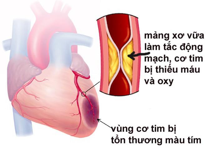 Vùng cơ tim bị tổn thương ở bệnh nhân mắc bệnh tim mạch.