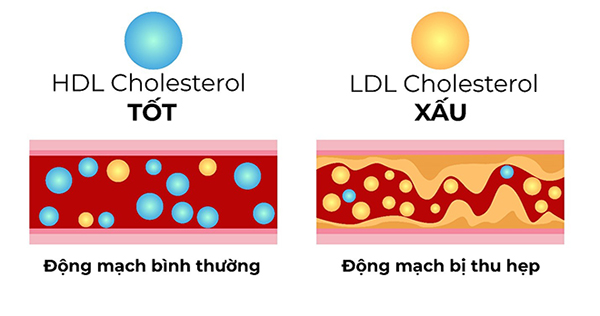 Hình ảnh mô tả 2 loại cholesterol trong cơ thể