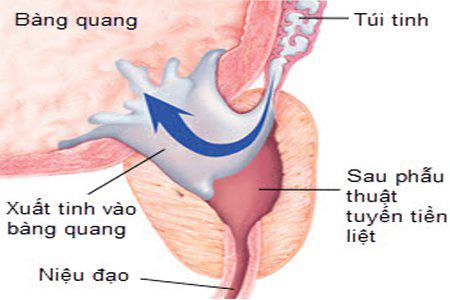 Xuất tinh ngược hay ngược dòng còn được gọi là cực khoái khô.