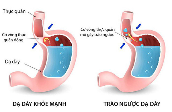 Dịch vị và các chất ở dạ dày trào ngược lên thực quản