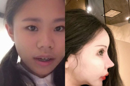 Cô gái Trung Quốc gây sốc với gương mặt nhọn hoắt chỉ vì thẩm mỹ "chui"