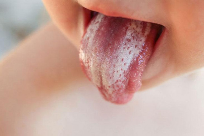 Mảng trắng trên lưỡi có thể là triệu chứng của bệnh tưa miệng do nhiễm nấm. Ảnh minh họa.