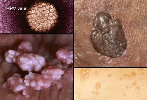 HPV gây bệnh mụn cóc sinh dục.