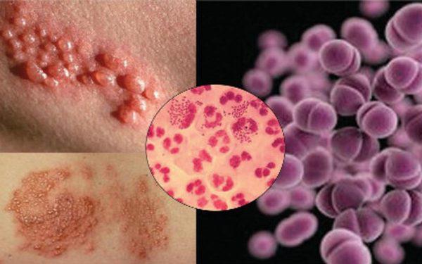 Vi khuẩn Neisseria Gonorrhoeae gây bệnh lậu.