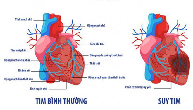 Suy tim: Nhận biết, nguyên nhân, điều trị và đề phòng biến chứng - 1