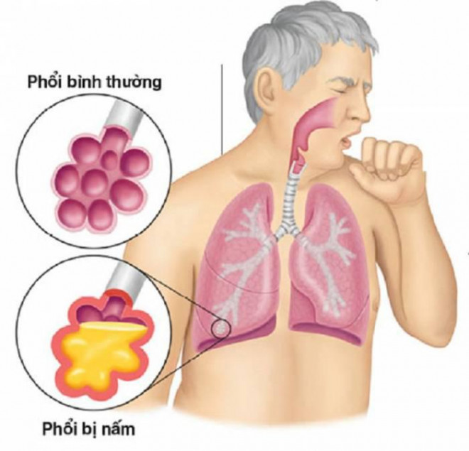 Chăm sóc phổi đúng cách trong mùa dịch COVID-19 - hình ảnh 4