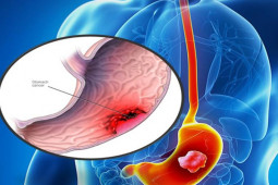 Ung thư dạ dày có biểu hiện rất mơ hồ, trường hợp nào nên đi khám ngay?