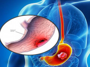 Sức khỏe đời sống - Ung thư dạ dày có biểu hiện rất mơ hồ, trường hợp nào nên đi khám ngay?