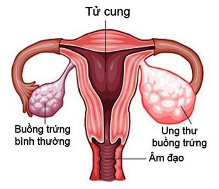 10 dấu hiệu khiến bạn nghĩ ngay đến ung thư buồng trứng - 2