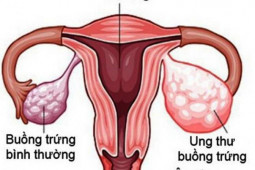 10 dấu hiệu khiến bạn nghĩ ngay đến ung thư buồng trứng