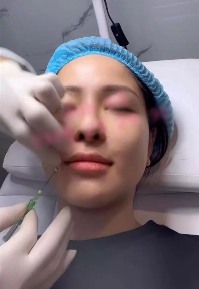 Mới đây, người đẹp chia sẻ việc tiêm filler để xóa rãnh cười.