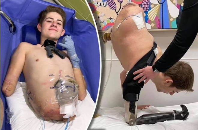 Chàng trai phải&nbsp;phẫu thuật cắt bỏ nửa thân dưới và cánh tay bên phải sau vụ tai nạn. Ảnh: Daily Mail