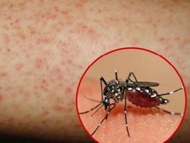 Hà Nội ghi nhận thêm 8 ổ dịch mới, triệu chứng cảnh báo nguy hiểm của sốt xuất huyết