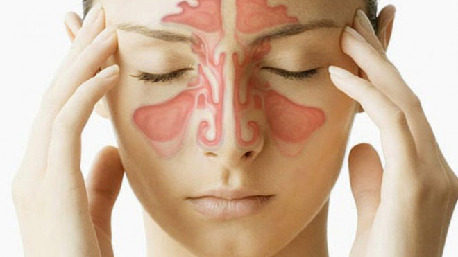 Viêm mũi xoang thường gây nhức đầu, nghẹt mũi, người mệt mỏi.