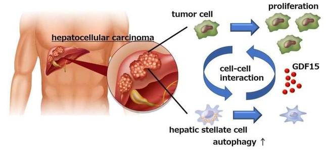 Các tế bào ung thư gan phát triển sau nhiều năm mắc bệnh mãn tính về gan.