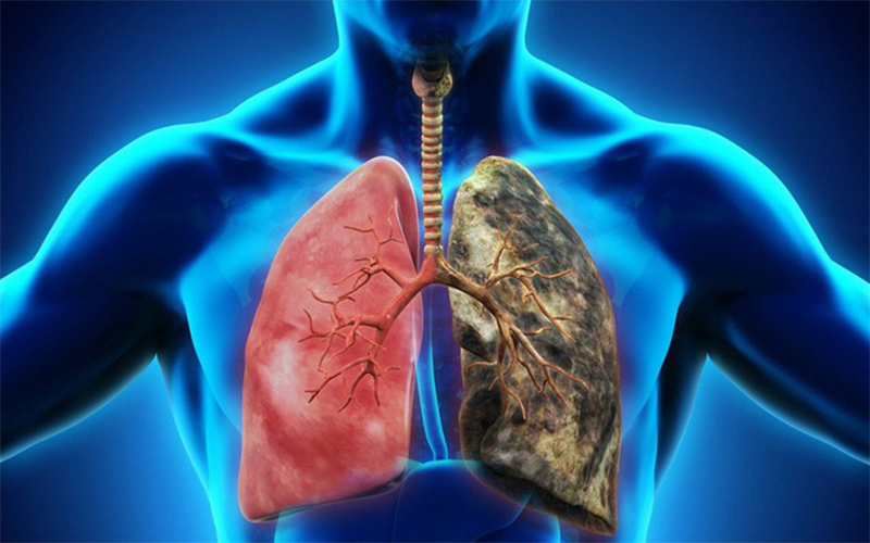 Những hiểu lầm thường gặp về bệnh ung thư phổi - 1