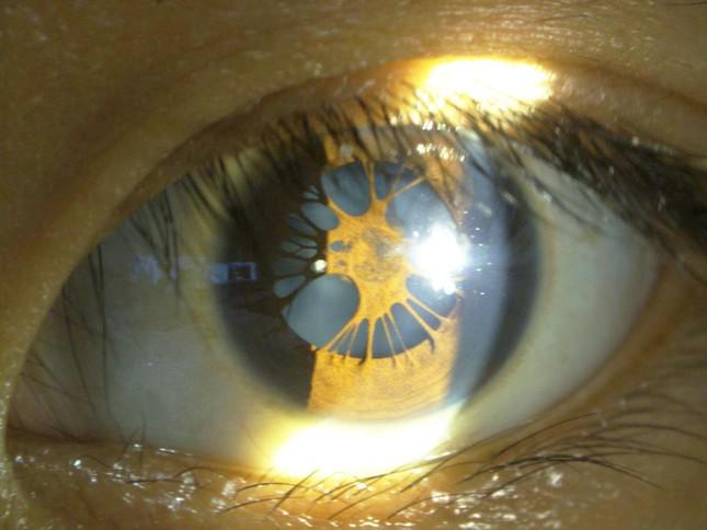 Hình ảnh "mạng nhện" giăng trong mắt bệnh nhân khi đến bệnh viện kiểm tra