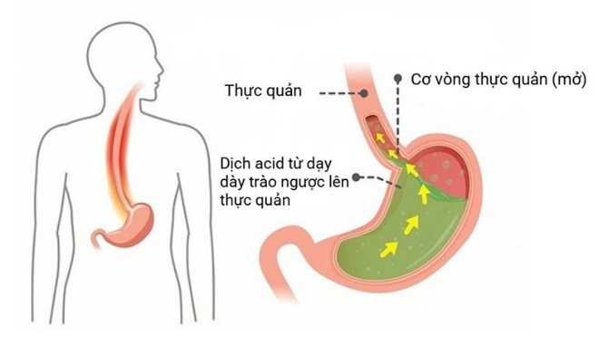 Khó thở, đau thượng vị liên miên, ung thư cần kề – Trào ngược đang “triệt tiêu” sức khỏe bạn như thế nào? - 3