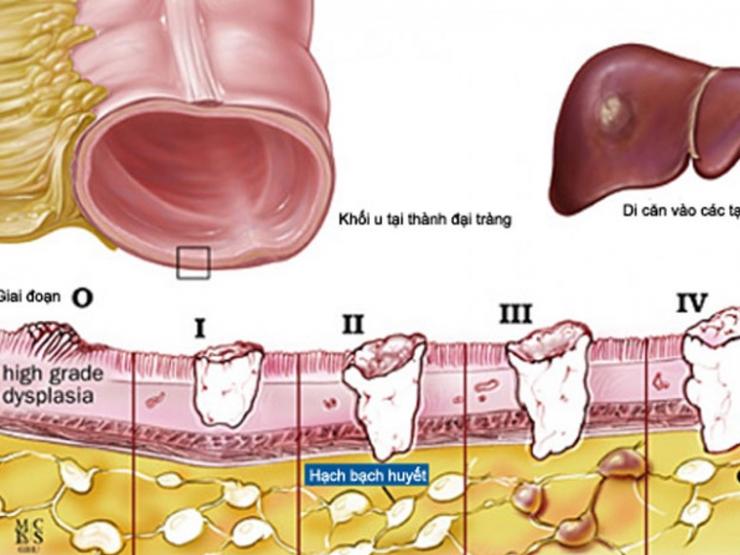 Ung thư đại trực tràng có chữa được không?