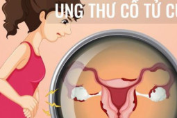 [Infographic] - Những hành vi làm tăng nguy cơ ung thư cổ tử cung