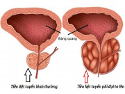 Sức khỏe đời sống - Phì đại tuyến tiền liệt: Cập nhật phương pháp xử lý bệnh hiệu quả, an toàn