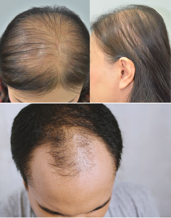Những sai lầm phổ biến khiến gội đầu dẫn đến rụng tóc