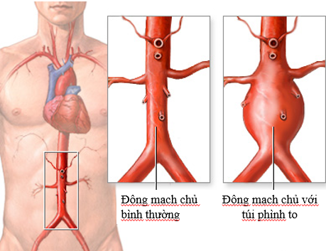 Căn bệnh khiến nghệ sĩ Bảo Anh &#39;Người đẹp Tây Đô&#39; qua đời ở tuổi 68 mắc phải nguy hiểm thế nào? - 2