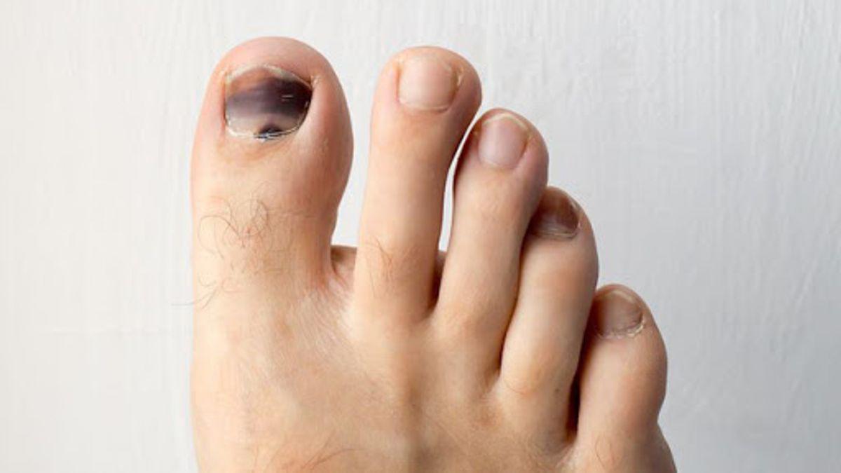 3 tình trạng này bất ngờ xuất hiện ở ngón chân hãy cẩn trọng, ung thư đang âm thầm tấn công bạn - 2
