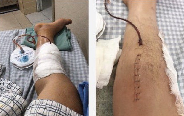 Người đàn ông 32 tuổi suýt mất chân vì sai lầm nhiều người Việt mắc phải - 1