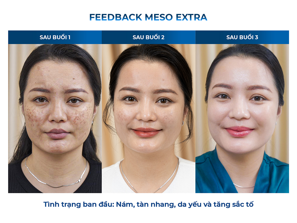 Biến chứng u hạt khi tiêm Meso giá rẻ - chia sẻ chuyên môn từ Bác sĩ da liễu Huỳnh Linh - 4