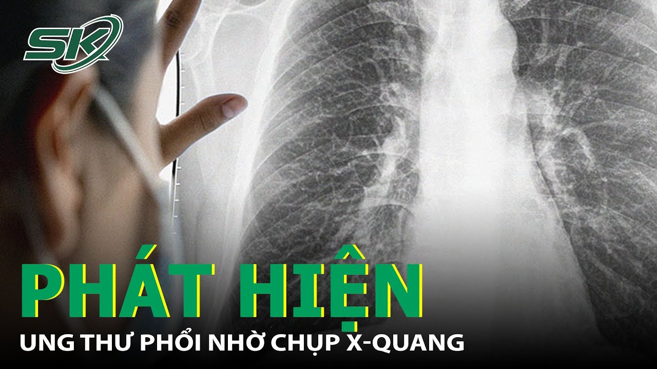 9 dấu hiệu cảnh báo ung thư phổi cần biết - 3