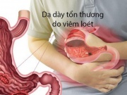 Sức khỏe đời sống - Ai bị đau dạ dày cần biết điều này, 5 thực phẩm nên ăn để phòng các cơn đau tái phát