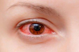 Nhiều gia đình nghỉ học, nghỉ làm vì đau mắt đỏ, Bộ Y tế khuyến cáo 5 biện pháp