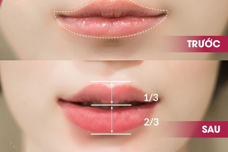 Tiết lộ 5 tiêu chí lựa chọn địa chỉ tiêm filler môi ở đâu tốt, đảm bảo an toàn - 5