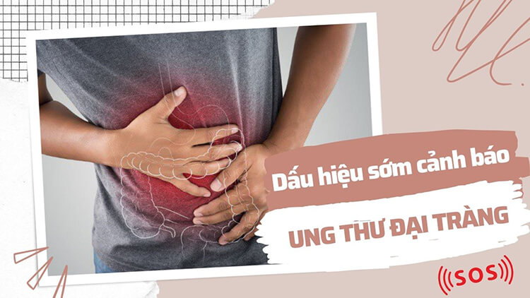 7+ dấu hiệu cảnh báo ung thư đại tràng sớm, đừng bỏ qua kẻo mất mạng - 1