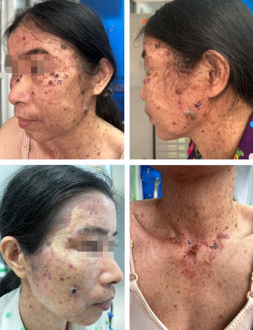 Người phụ nữ có gần 20 tổn thương ung thư da ở mặt, cổ - 1