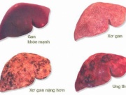 Sức khỏe đời sống - Những ai có nguy cơ mắc căn bệnh ung thư gây tử vong nhiều nhất tại Việt Nam?