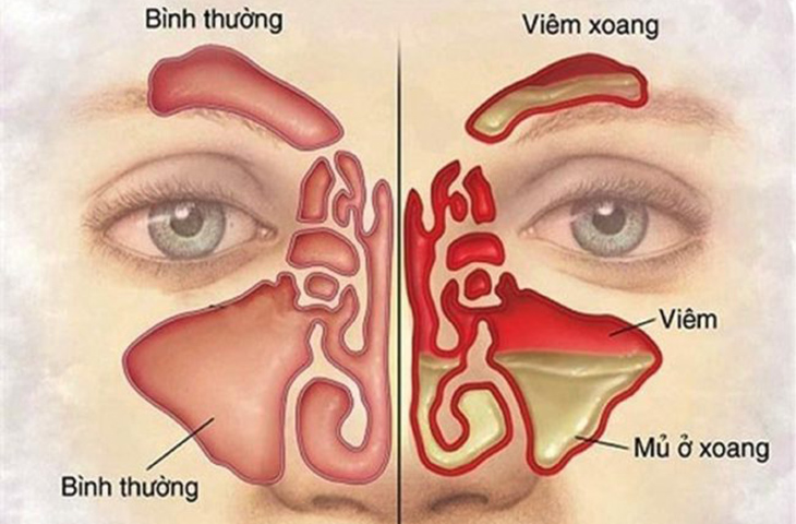 Nghẹt mũi một bên luân phiên kéo dài - Dấu hiệu nhiều bệnh lý mũi xoang nghiêm trọng - 3