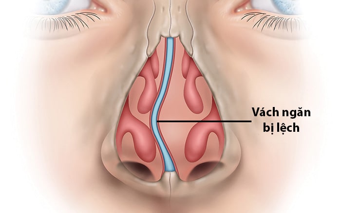 Nghẹt mũi một bên luân phiên kéo dài - Dấu hiệu nhiều bệnh lý mũi xoang nghiêm trọng - 4