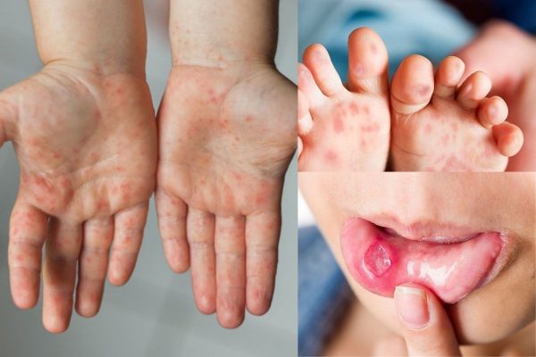Bệnh tay chân miệng có biểu hiện đặc trưng là các mụn nước mọc ở tay, chân, miệng