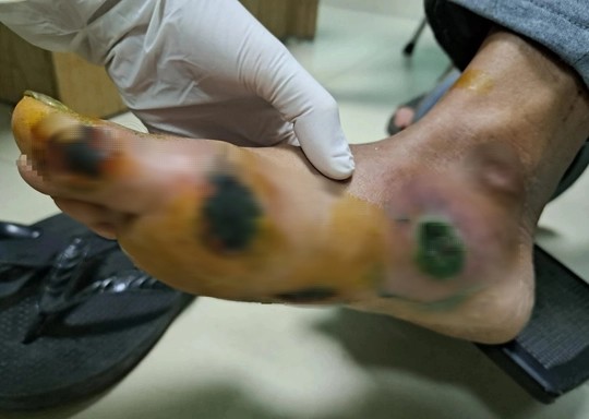 Bệnh nhân đái tháo đường loét bàn chân do thói quen thường gặp - 1