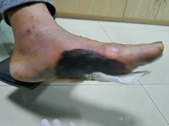 Bệnh nhân đái tháo đường loét bàn chân do thói quen thường gặp - 2