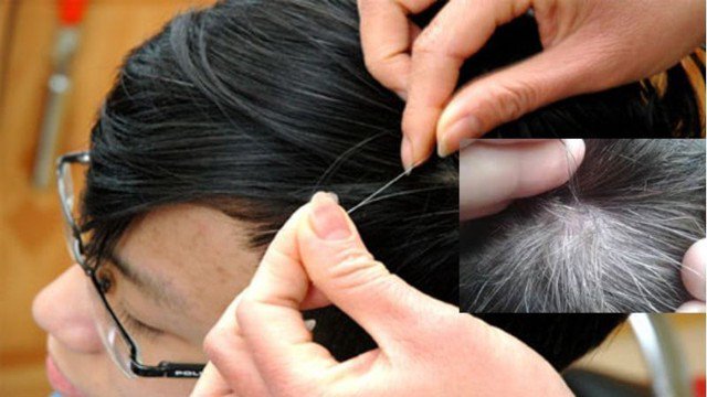 Còn trẻ mà bị tóc bạc sớm cùng với dấu hiệu này thì cần khám ngay còn kịp, đây là cách tốt nhất để ngăn chặn tóc bạc sớm! - 1