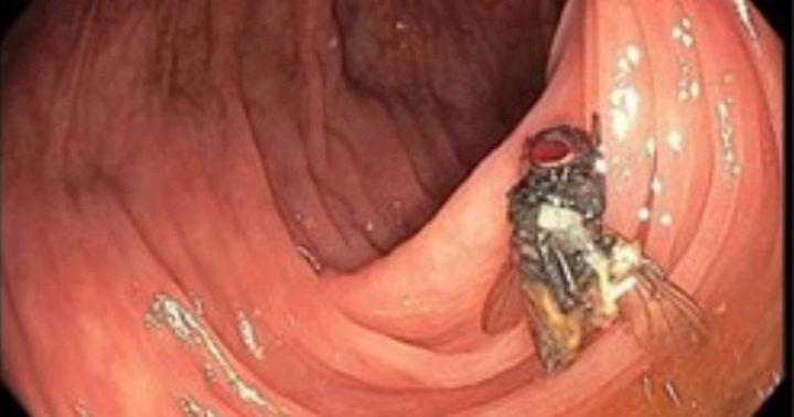 Bác sĩ phát hiện con ruồi còn nguyên vẹn khi nội soi đại tràng bệnh nhân - 1