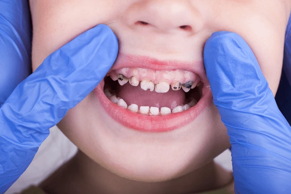 Cần ngừa sâu răng cho trẻ ngay từ nhỏ