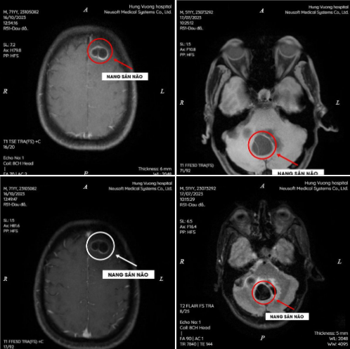 Hình ảnh nang sán não trên phim chụp MRI sọ não.