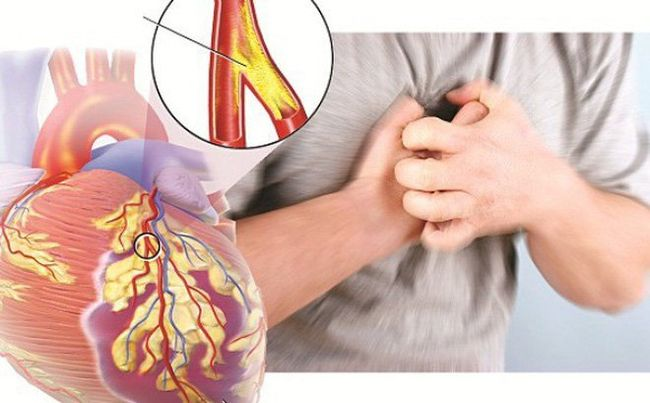 Suy tim là một biến chứng nguy hiểm của bệnh mạch vành
