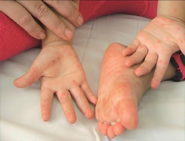 Cách chăm sóc trẻ bị bệnh tay chân miệng độ 1 tại nhà mẹ nên tham khảo - 1