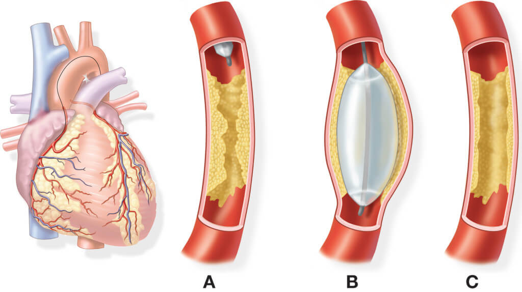 Nguy cơ suy tim do bệnh động mạch vành và cách phòng ngừa - 3
